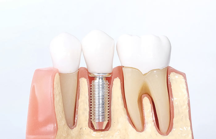 Tratamiento de implantes dentales