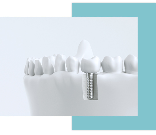 Colocación de un implante dental