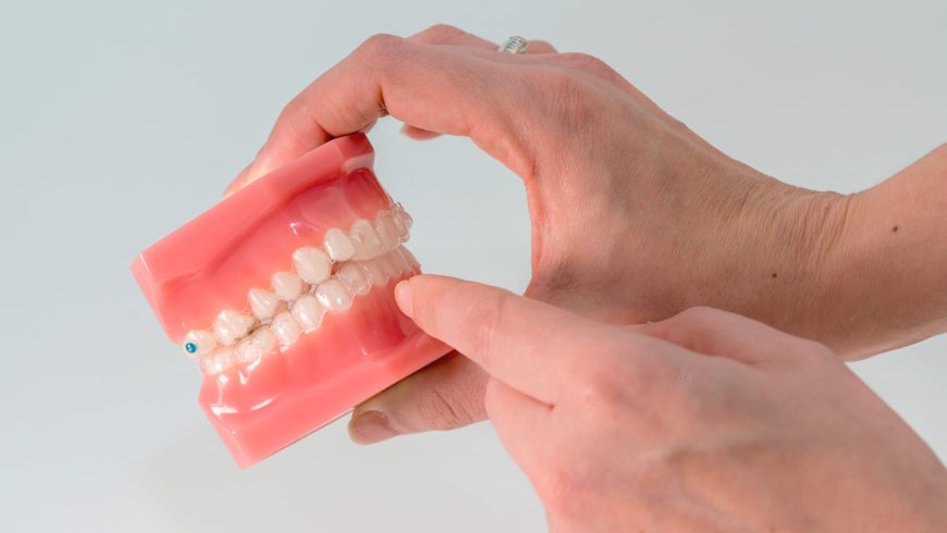 Ortodoncia invisible Invisalign, ¿cuáles son sus ventajas?