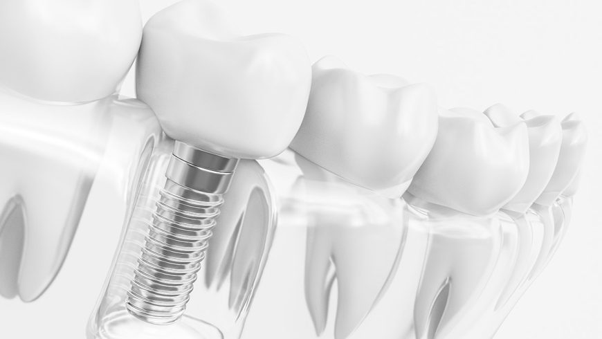 ¿Cuáles son los beneficios de los implantes dentales?