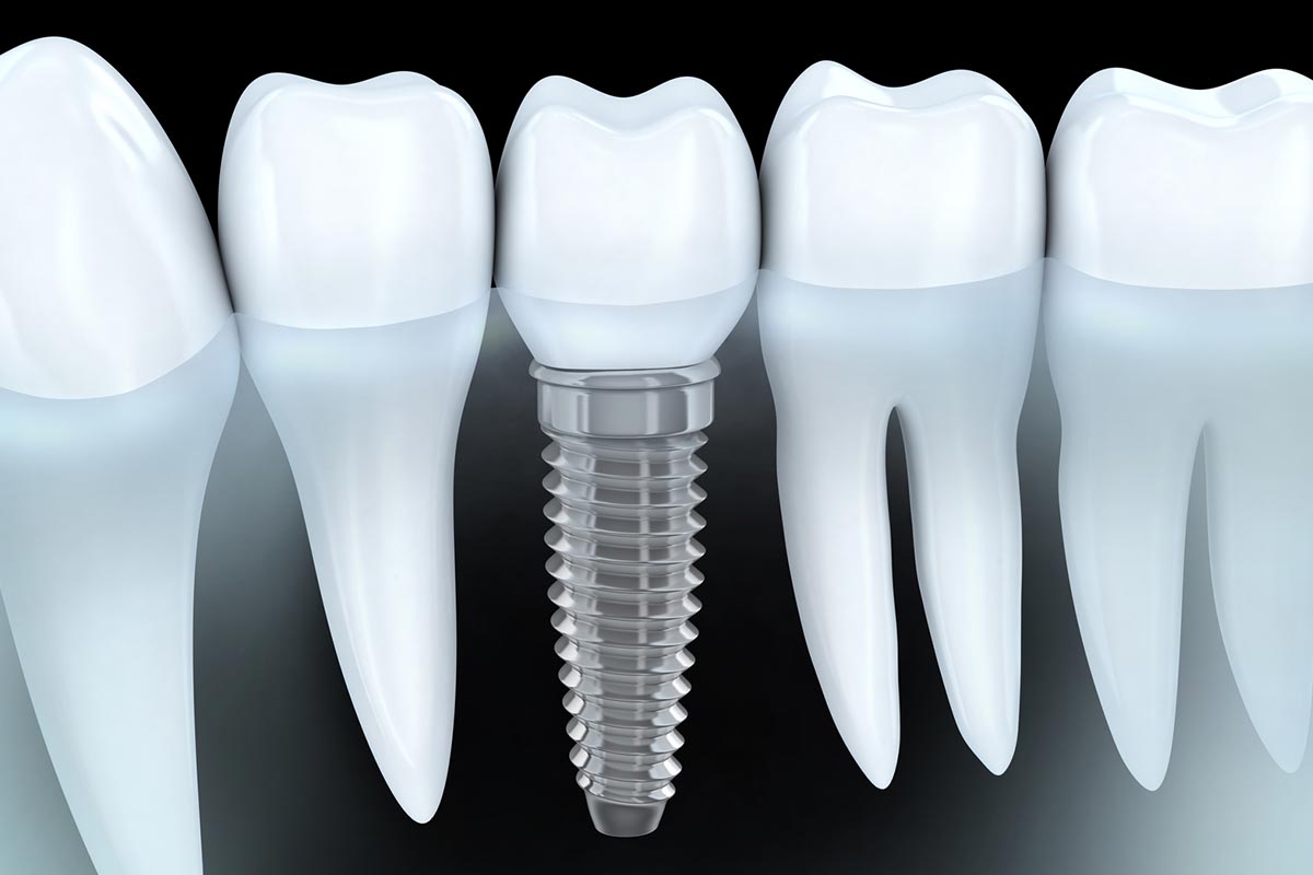 Colocación implantes dentales