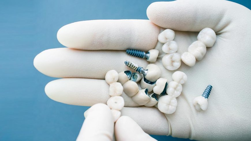 ¿Los implantes dentales duran toda la vida?