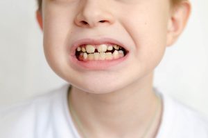 Motivos dientes amarillos en niños