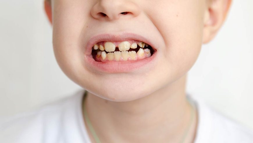 ¿Cuáles son las causas de los dientes amarillos en niños?