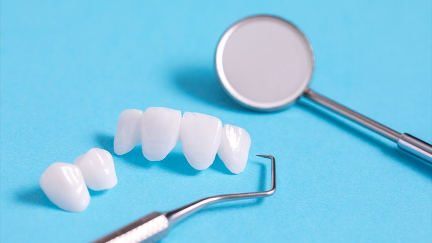 ¿Qué son las carillas dentales?