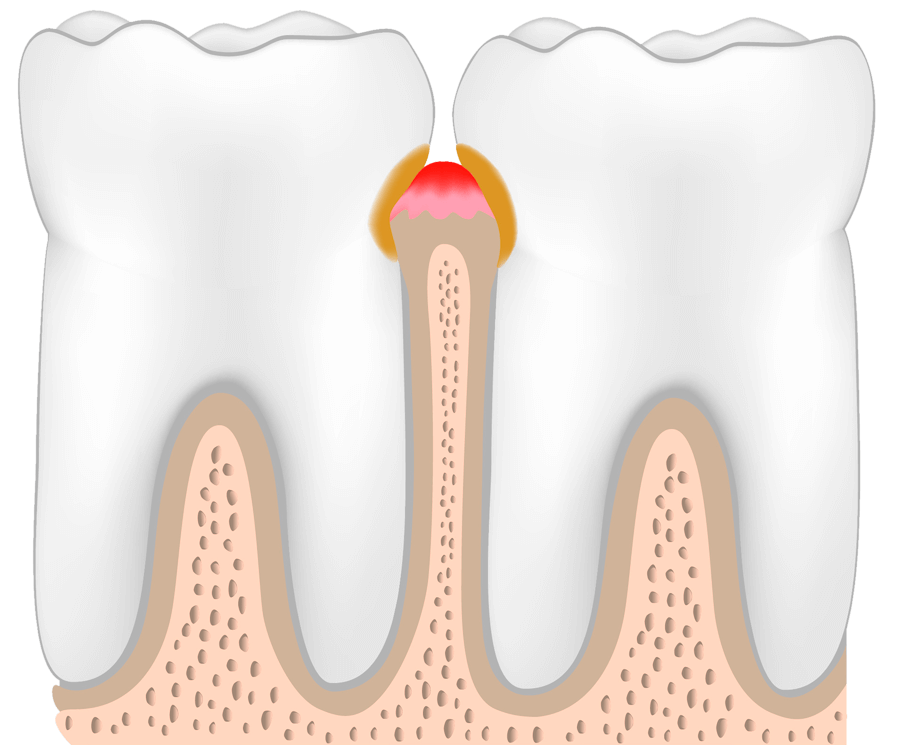 gingivitis periodoncia