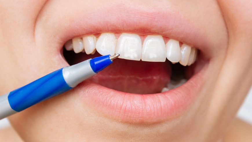 ¿Por qué salen manchas blancas en los dientes?