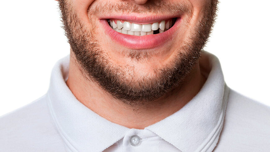 ¿Se pueden poner dientes sin implantes?