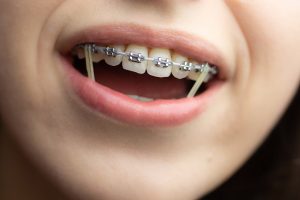 Brackets gomas