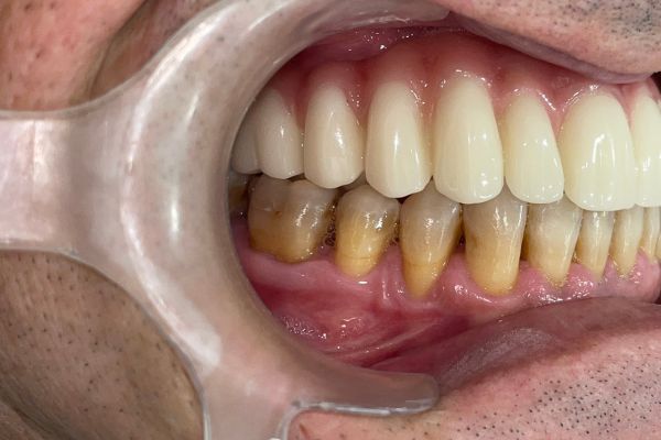 Fotografía lateral derecha con la dentadura definitiva.