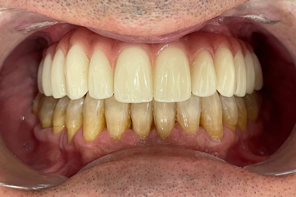 Fotografía con la dentadura definitiva, frontal.