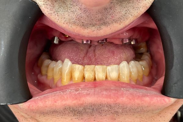 Imagen de la operación tras la colocación de los implantes.