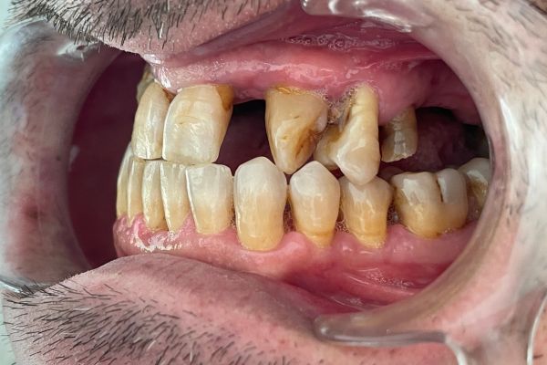 Situación del caso 233. Foto intraoral lado izquierdo.