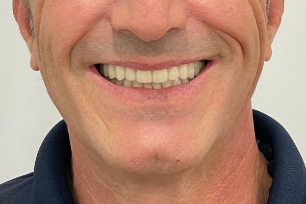 Resultado final con dentadura superior gracias a implantes.