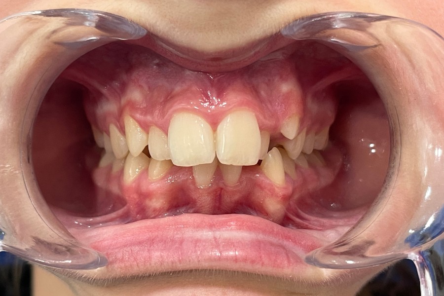 Etapa de descanso durante reposición y crecimiento dental.