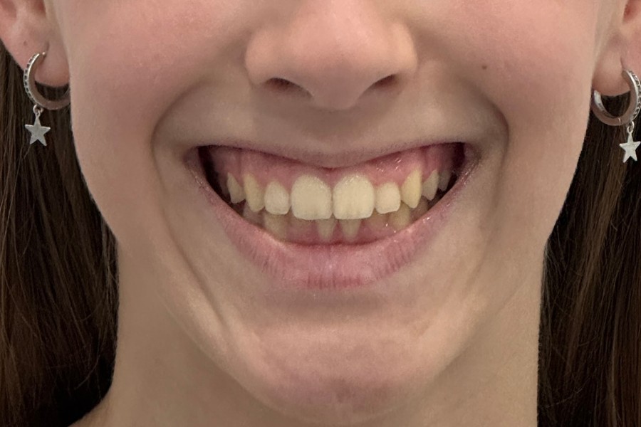 Aspecto de la sonrisa del caso 55 al terminar su tratamiento.
