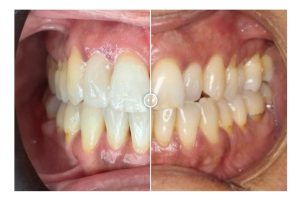Caso 292 en Clínica Dental Martínez Avilés, Torremolinos.
