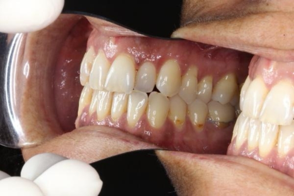 Aquí se ve cómo parte de los dientes superiores "cierran" por detrás que los inferiores.