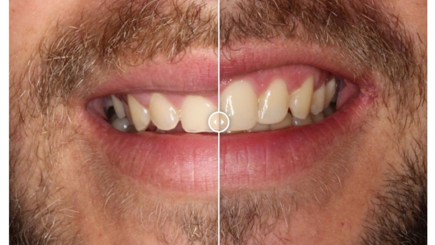 Caso 98: tratamiento de dientes pequeños en Torremolinos.