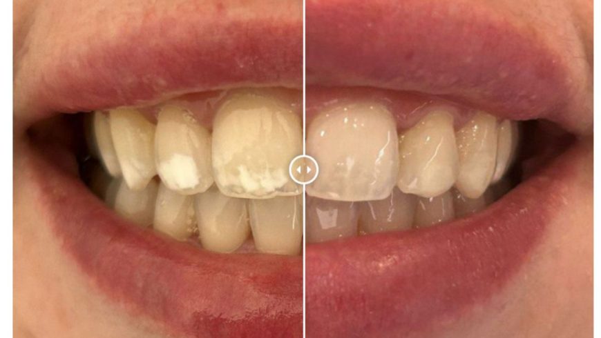 Caso 121: tratamiento de manchas blancas con resina ICON en Torremolinos.