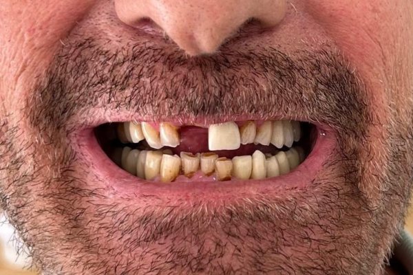 Tratamiento dental integral en 6 meses, Torremolinos. Antes.